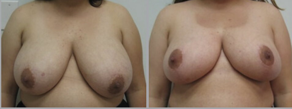 Breast Reduction in Ventura, CA